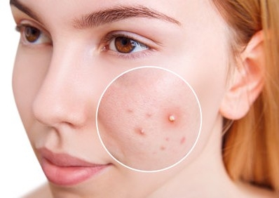 Veido valymas paaugliams