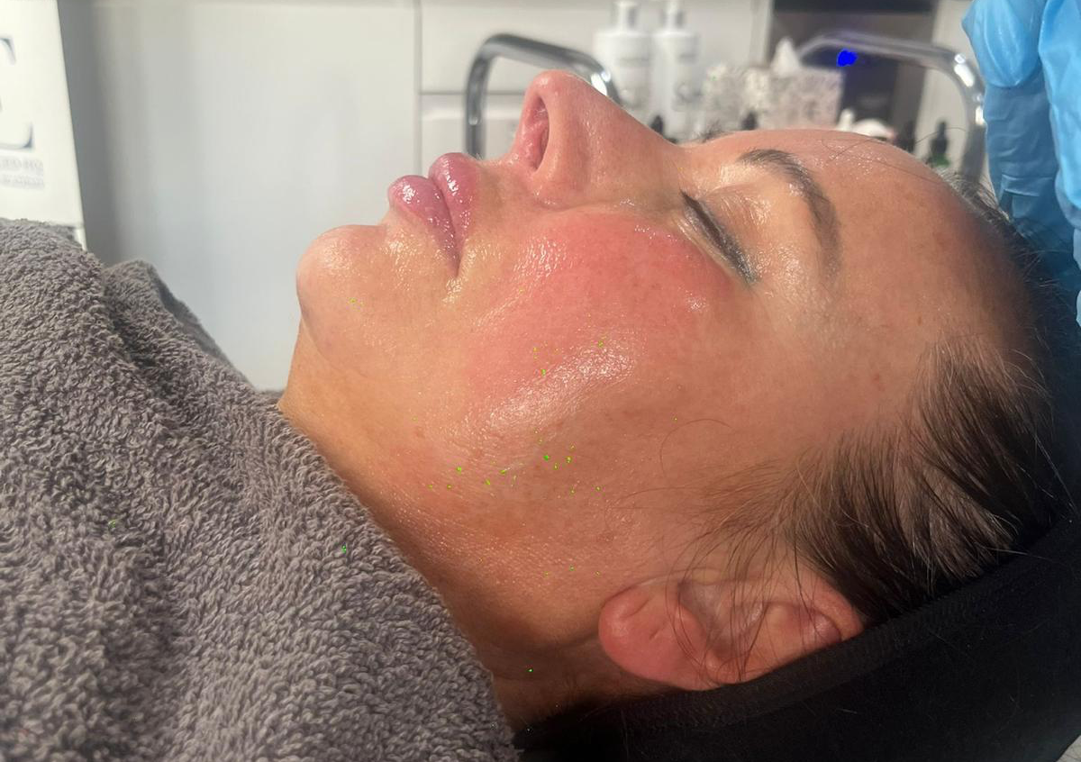 Chemical Peel 