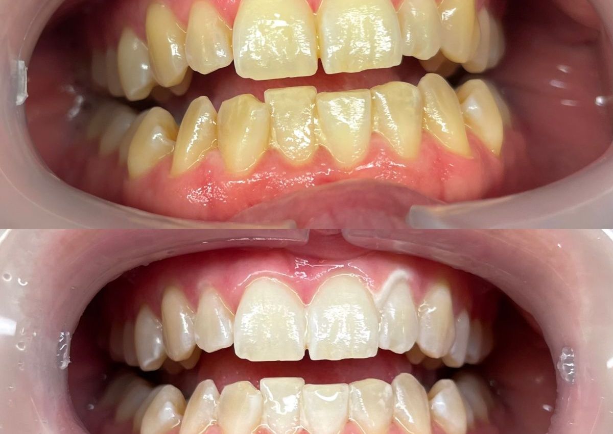 1er rdv blanchiment dentaire