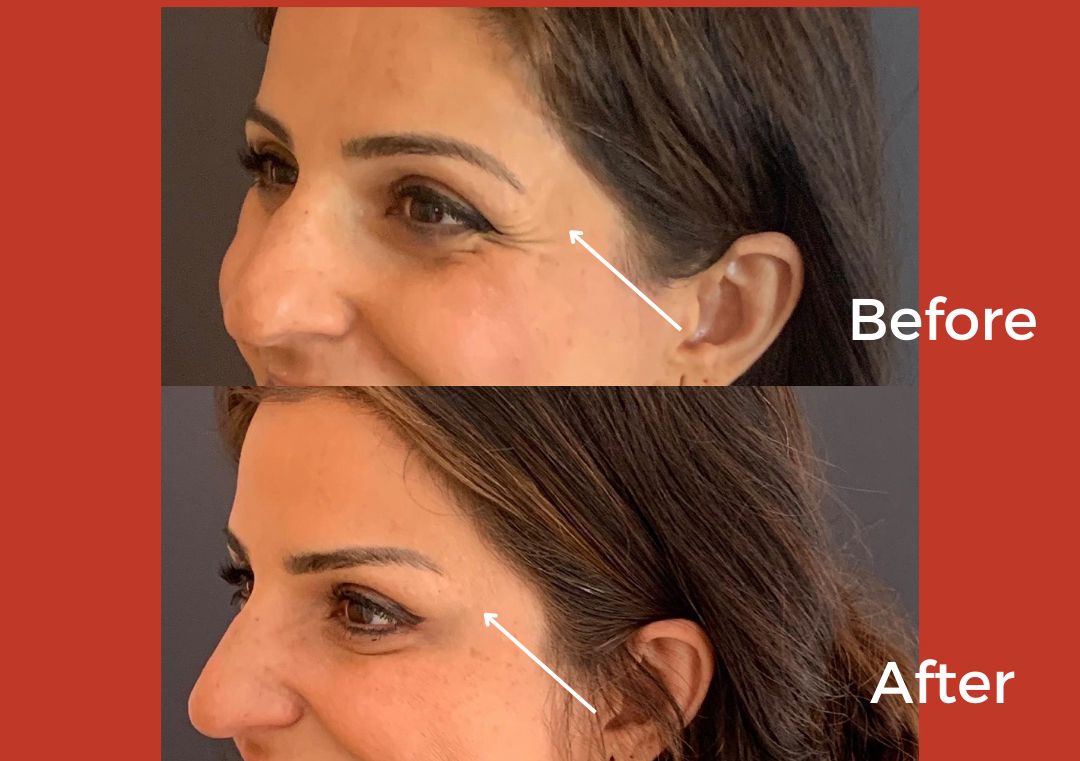 Brow Lift رفع الحاجب الخفيف 	