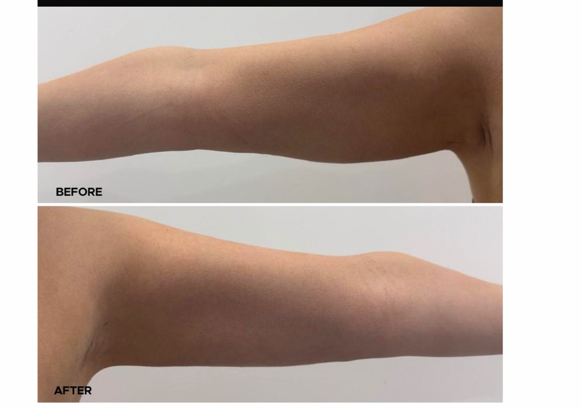 Endolift arms