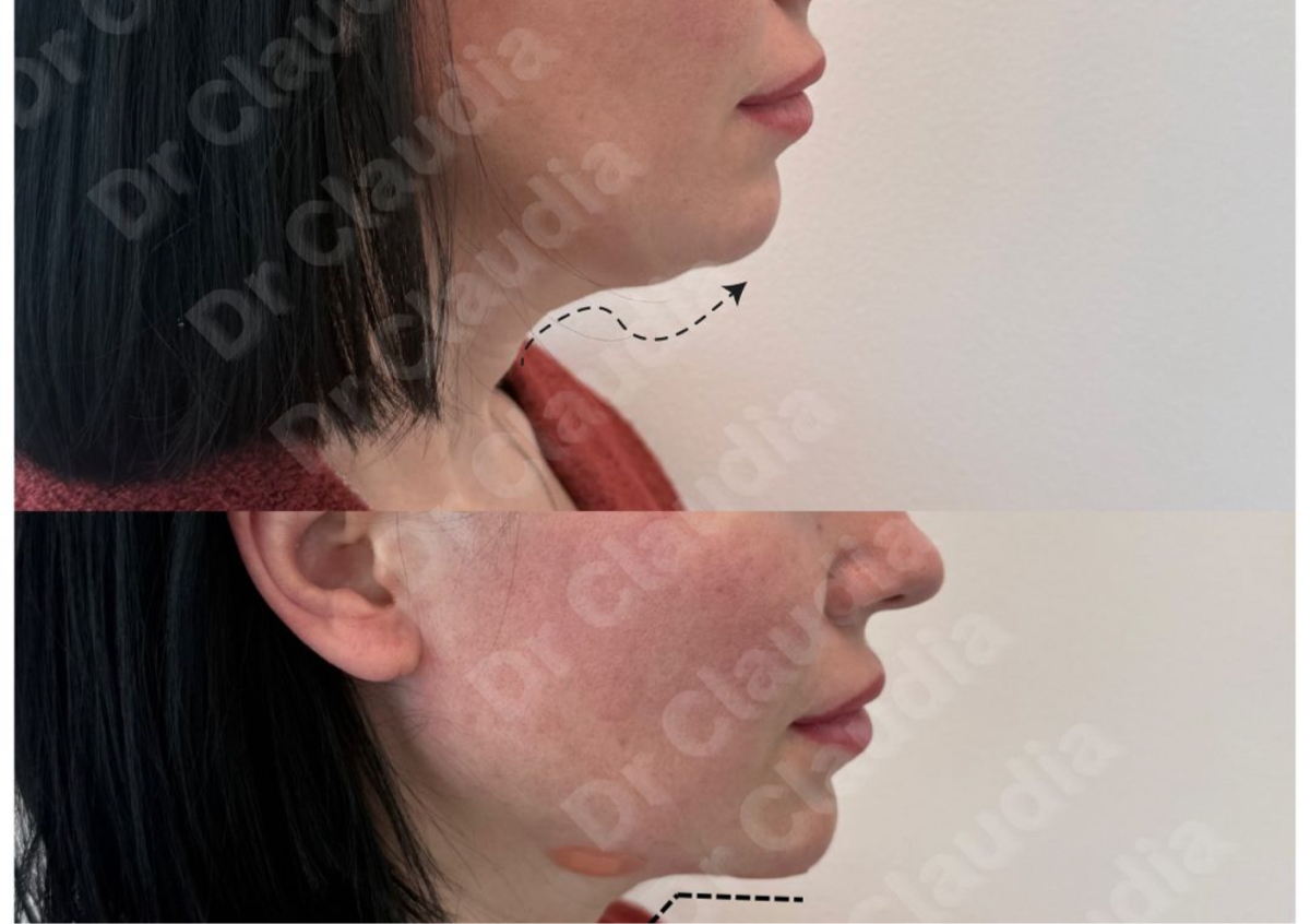 Endolift double chin