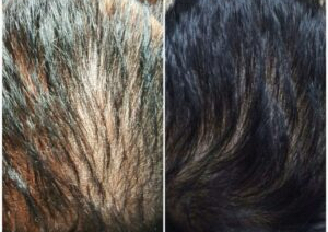 Regenera (3 session PRP + 3 session Mesotheraphy)