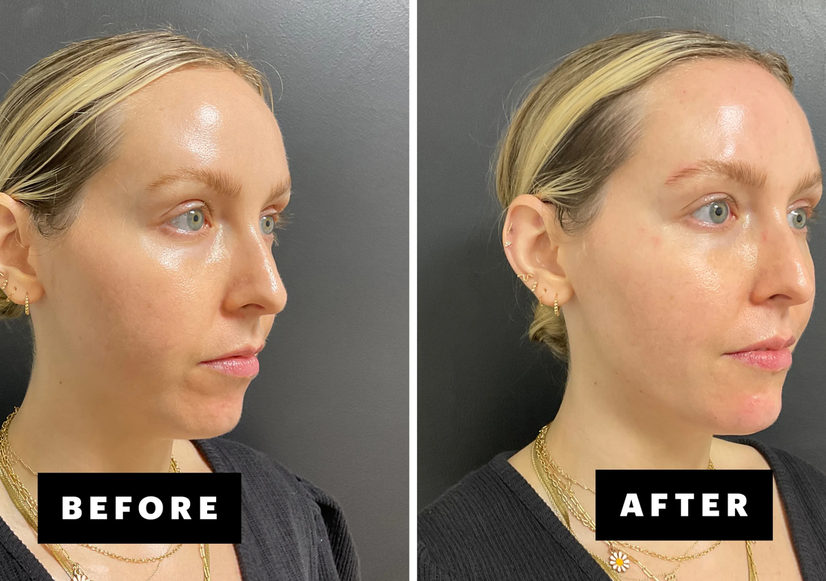 Chin filler 
