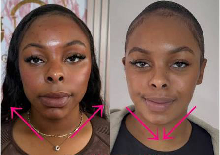 Masseter Muscle – Face Slimming / Teeth Grinding Treatment عضلة الفك (Masseter) – تنحيف الوجه / علاج صرير الأسنان 