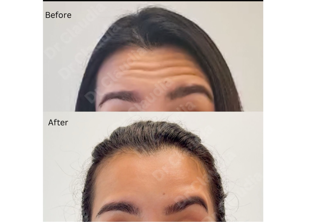 Allergan botox 