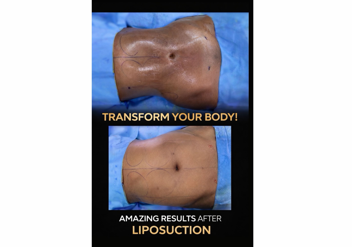 Lipo suction 360 