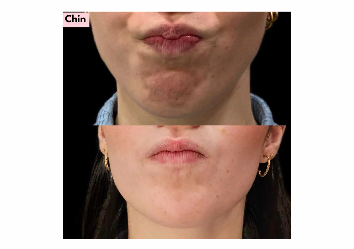 Dimpled Chin الذقن المتجعد