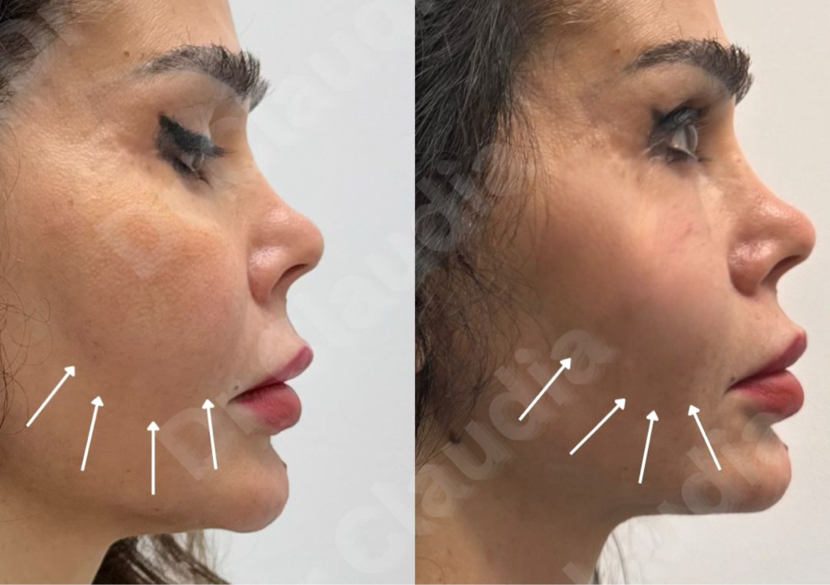 Endolift Face 