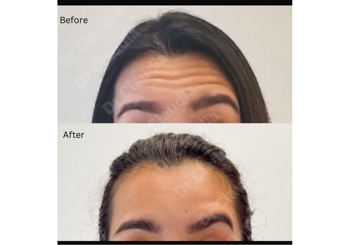Botox Nabota 