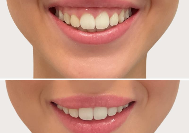 Gummy Smile الابتسامة اللثوية 