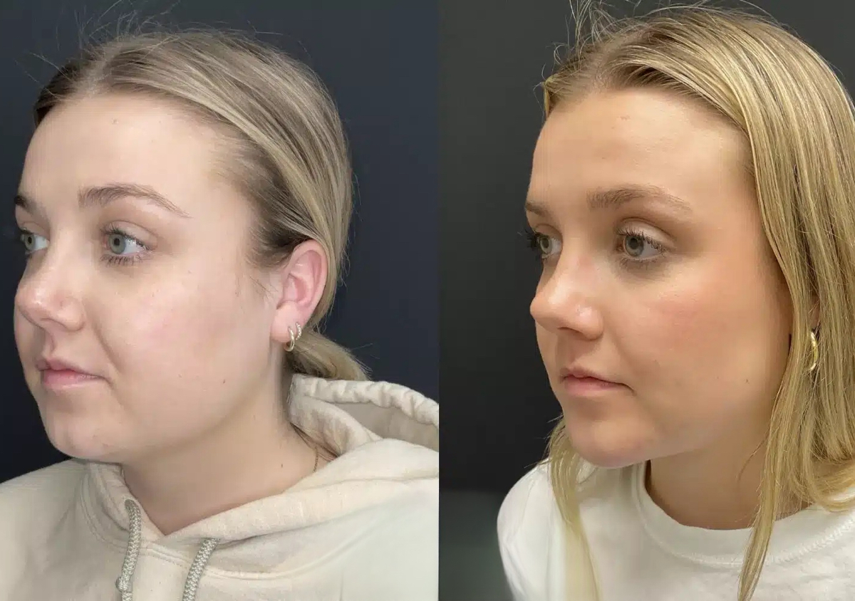 Bucal fat removal 