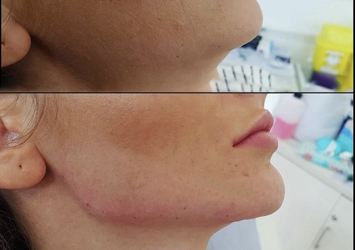 Jawline filler per ml 