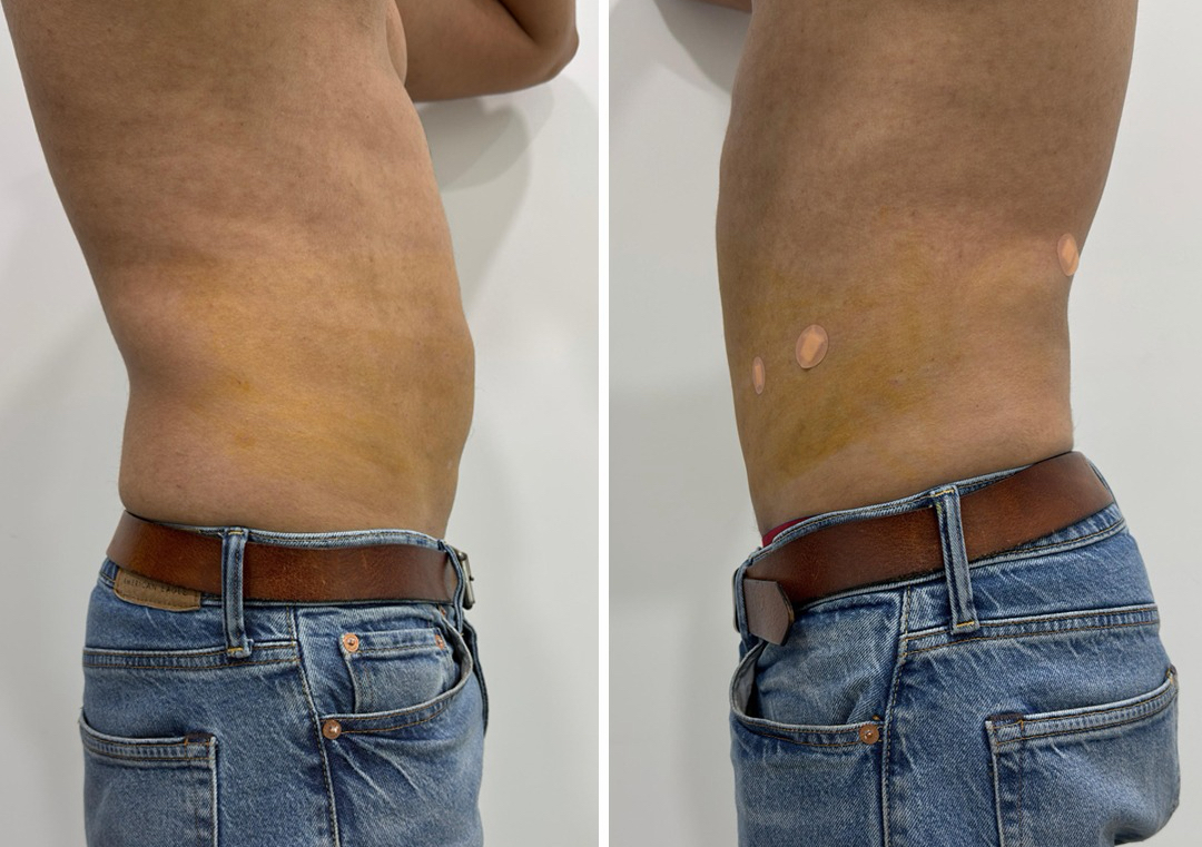 Endolift lower Abdomen