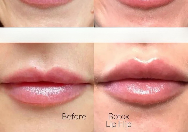Lip Flip إبراز الشفاه بدون فيلر 