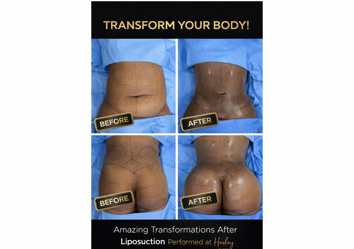 Liposuction + BBL 