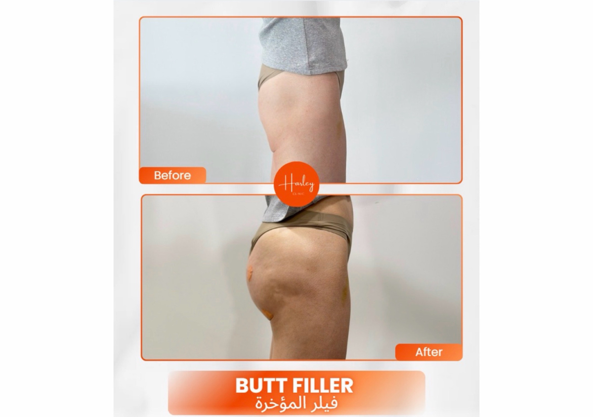 2000 ml butt and breast filler 