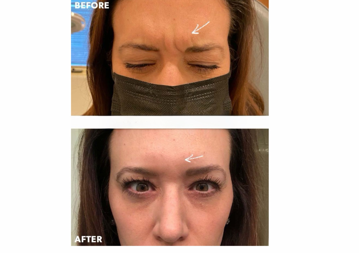 Glabella / Frown Lines خط العبوس بين الحاجبين 	