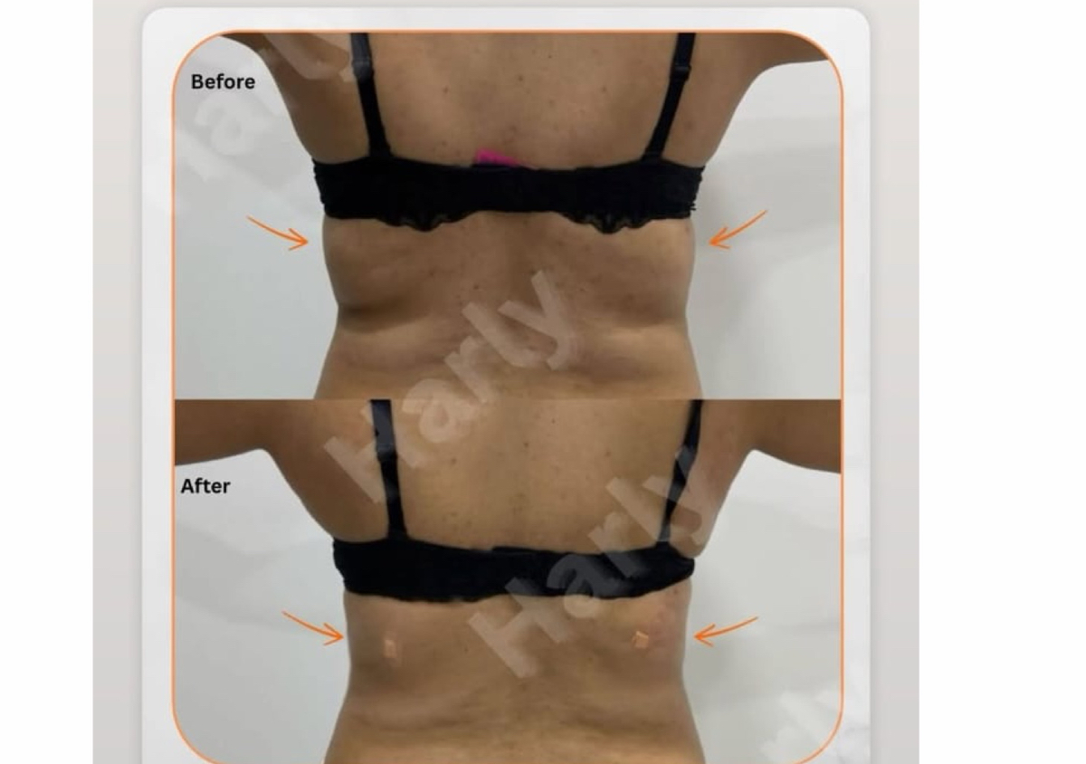 Endolift lower back 