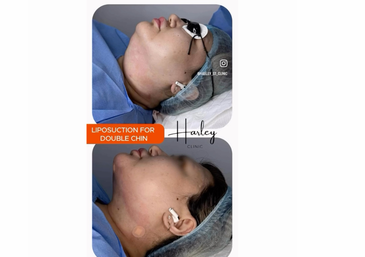 Double chin lipo suction 