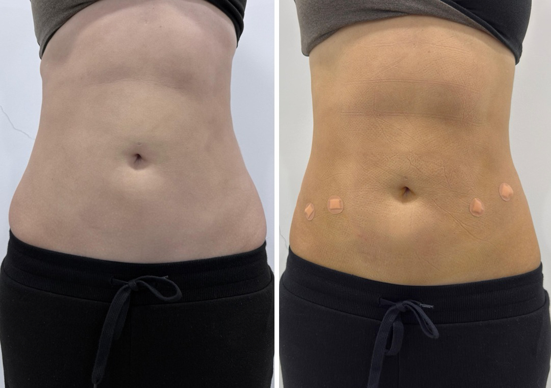 Endolift upper abdomen 