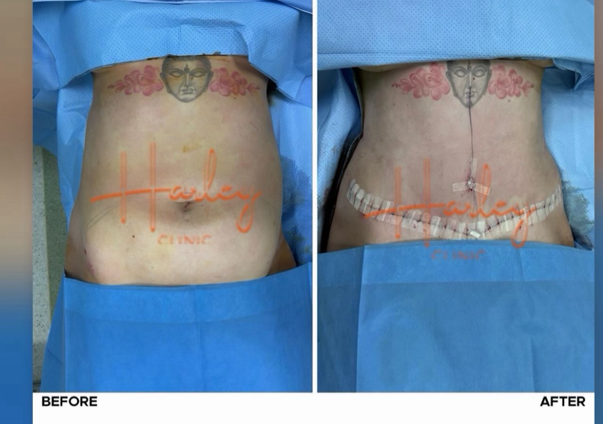 Tummy tuck