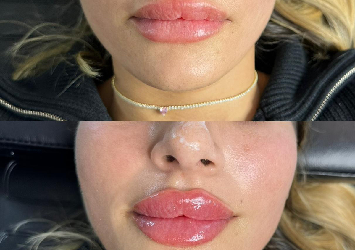 Lip Filler