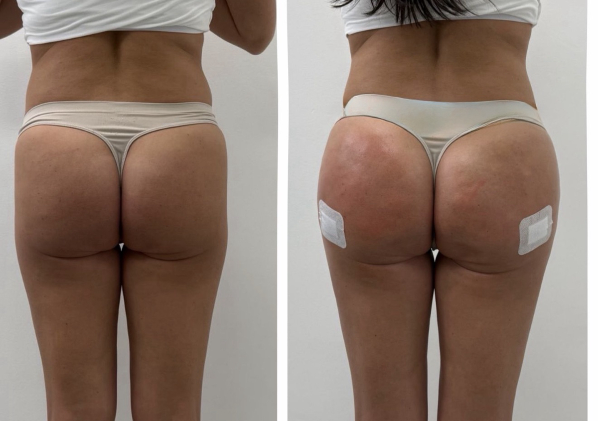 1000 ml butt or breast filler 