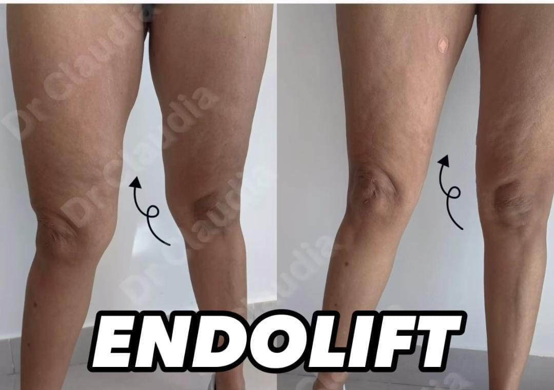 Endolift outer thighs 