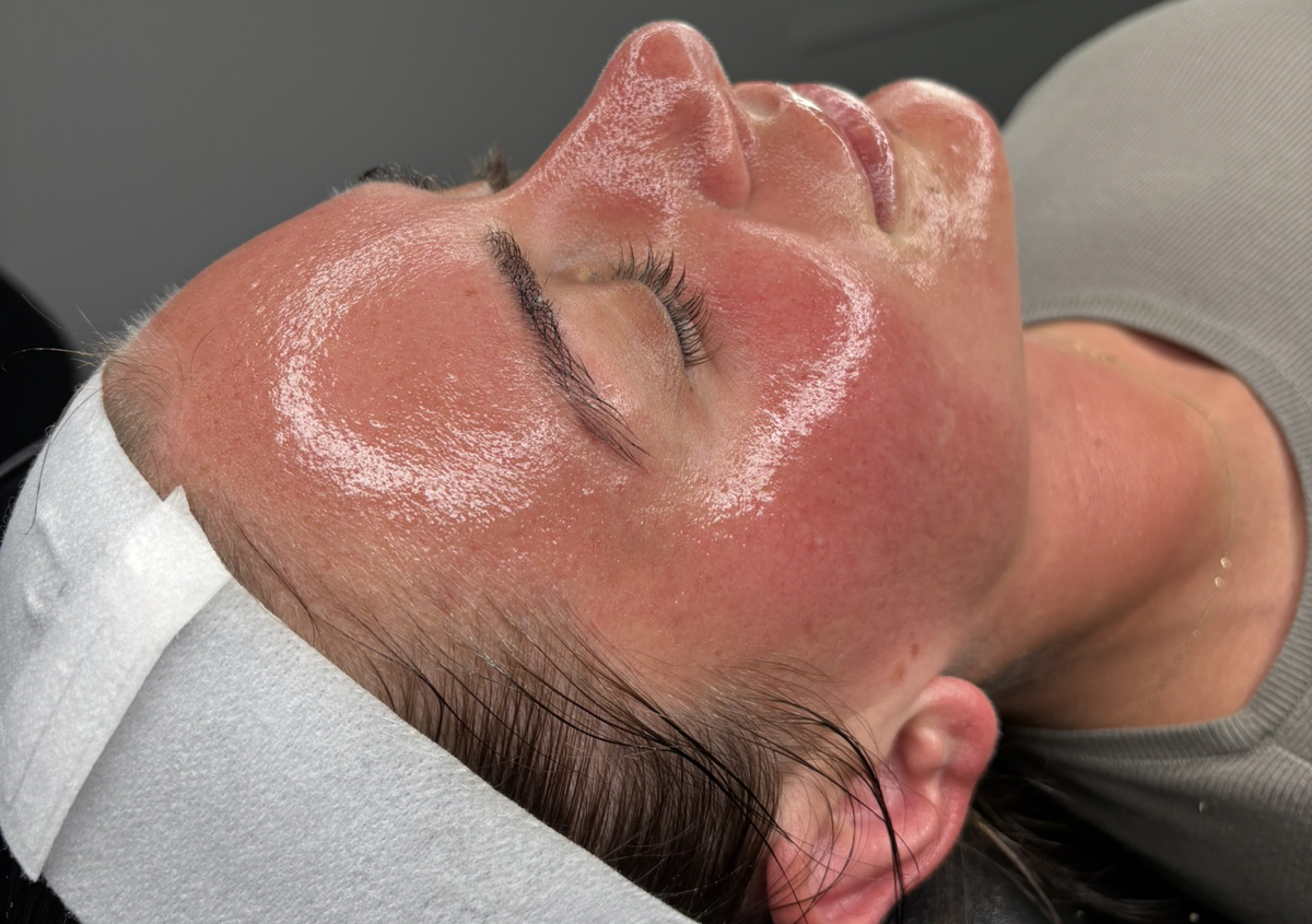 Microneedling with Polynucleotides (Salmon DNA)