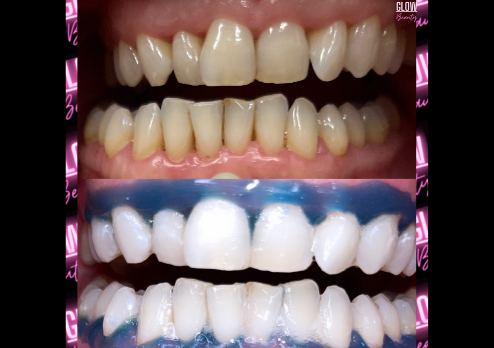 60 Min Max White Teeth Whitening Session