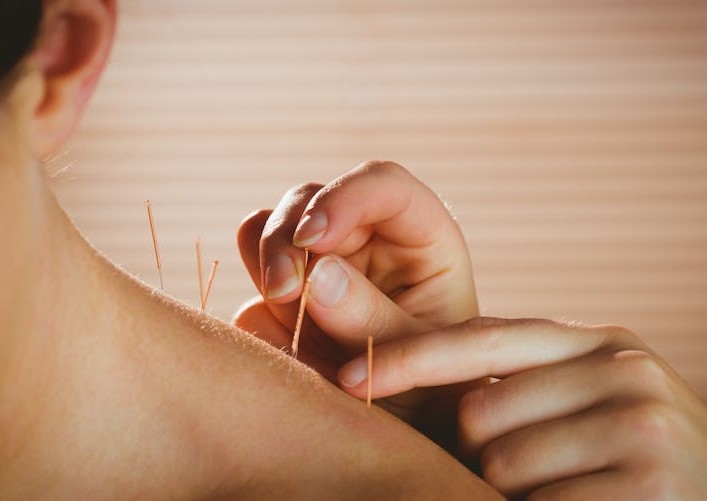 Accupuncture + Reiki