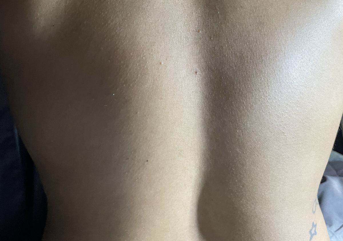 Bacial (Back facial)