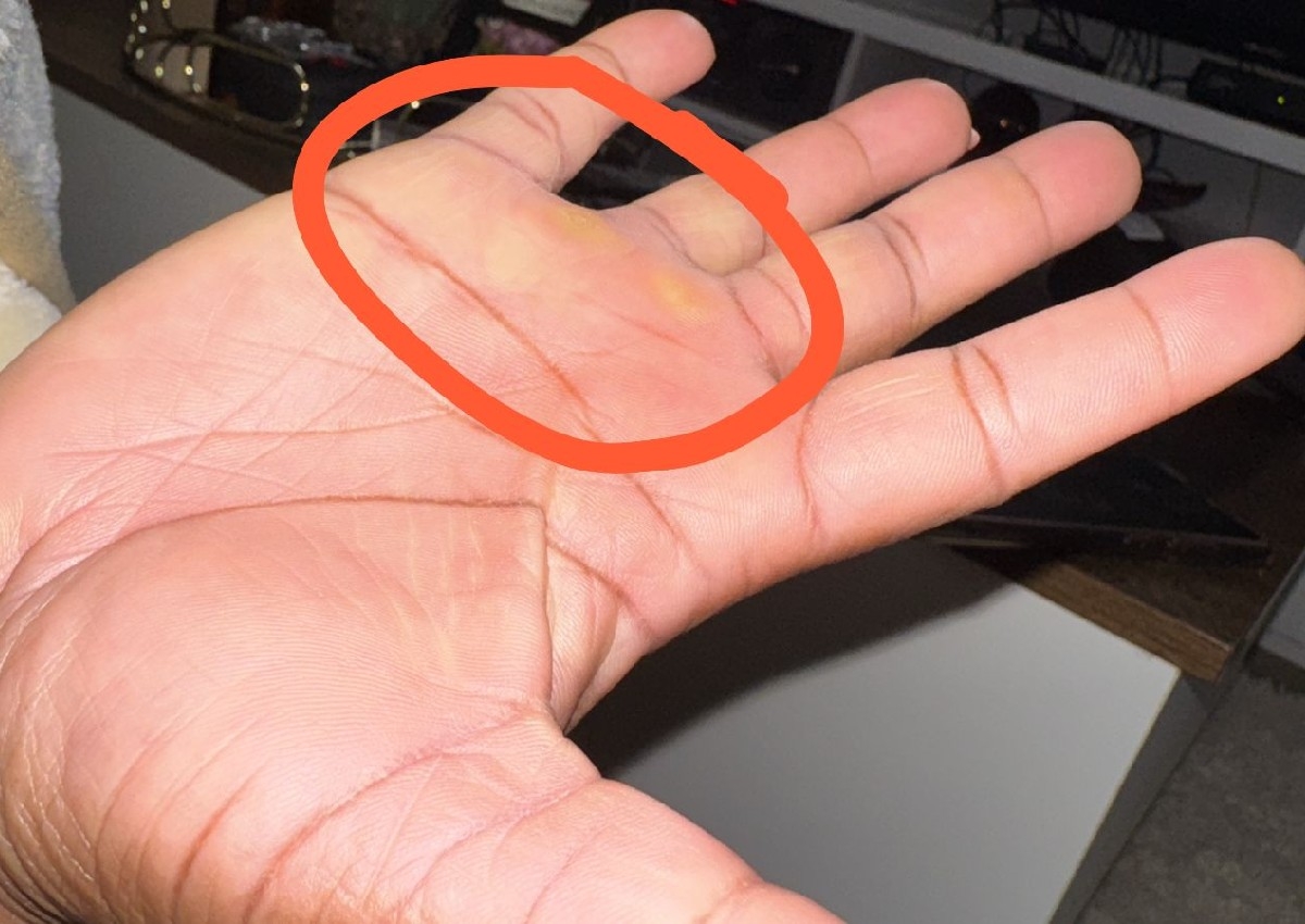 Removal of corns (hands)