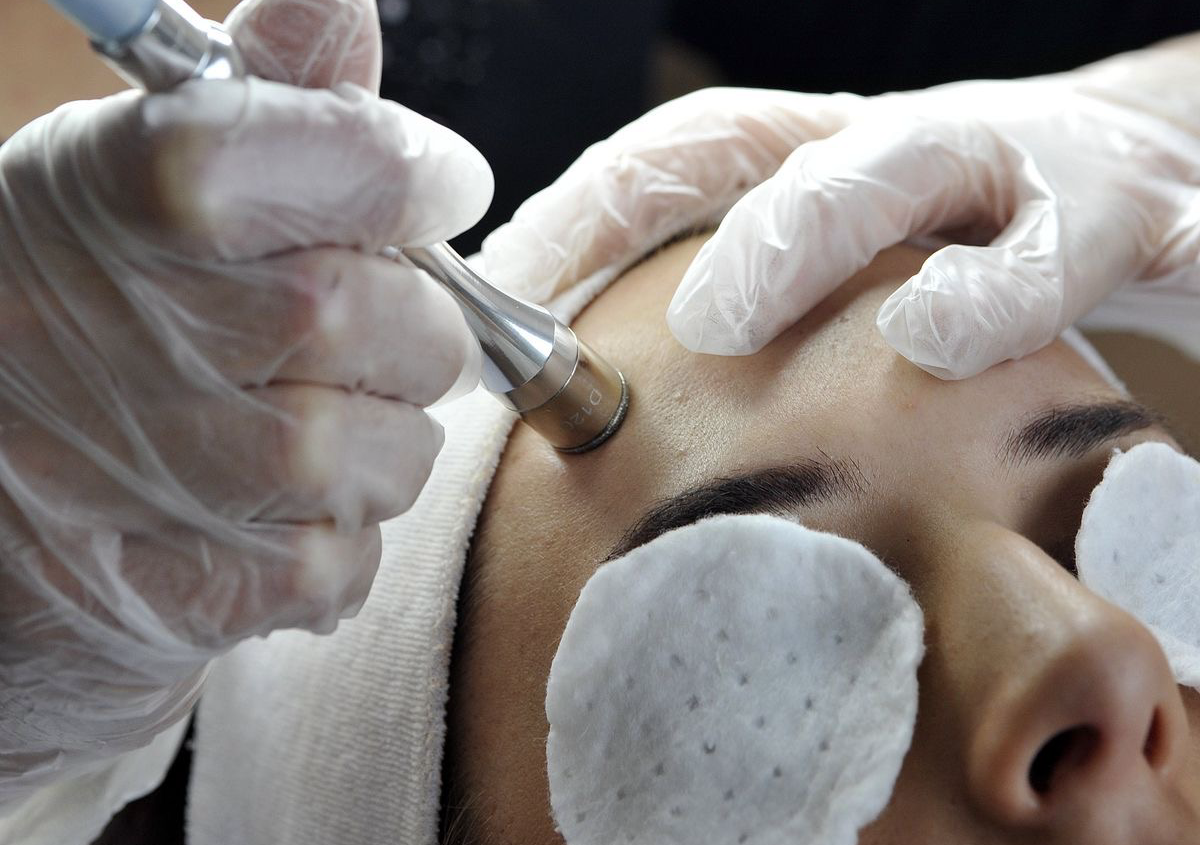 Microdermabrasion 