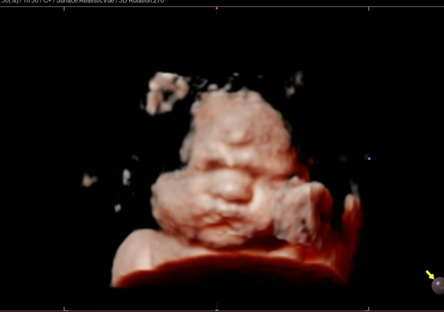 Wombmate Eviction (36+weeks) 