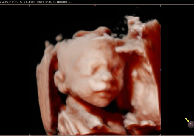 Wombmate Spotlight (up to 25 weeks)