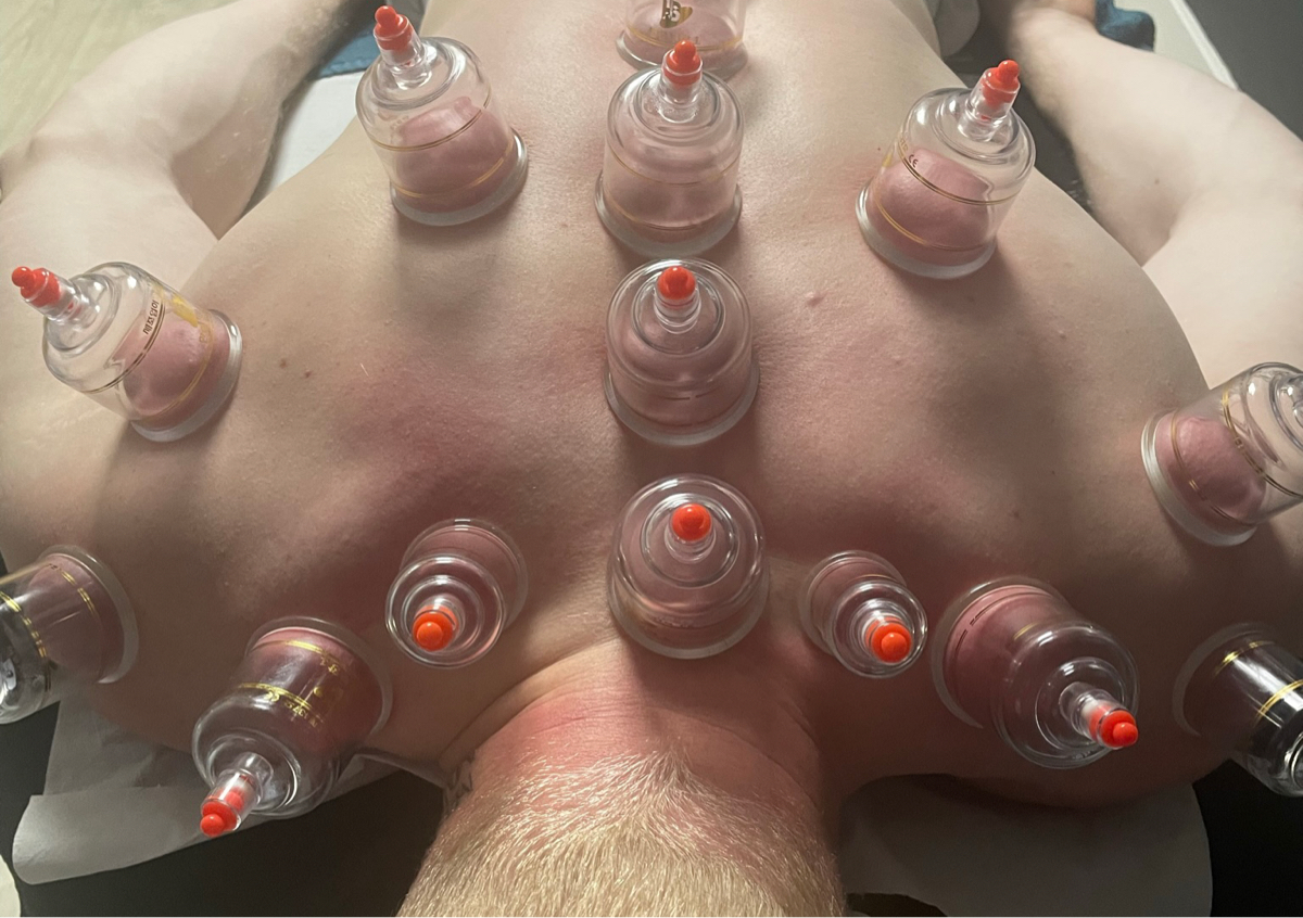 Cupping 