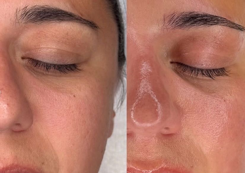 Peeling cavitațional+ Mezoterapie Virtuală