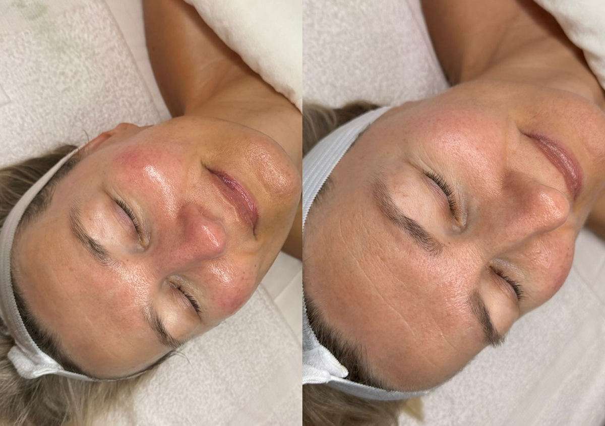 Microdermoabraziune +Oxigen Hiperbaric