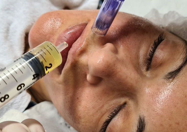 Microneedling / DermaPen