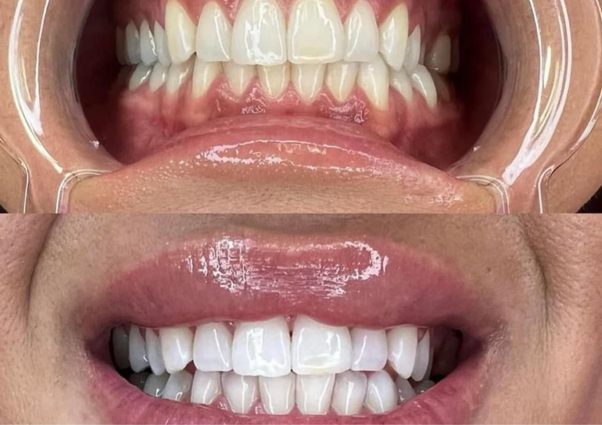 Cosmetic Teeth Whitening 