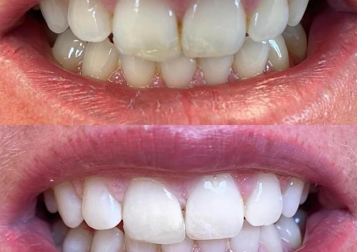 Cosmetic Teeth Whitening & Reflexology