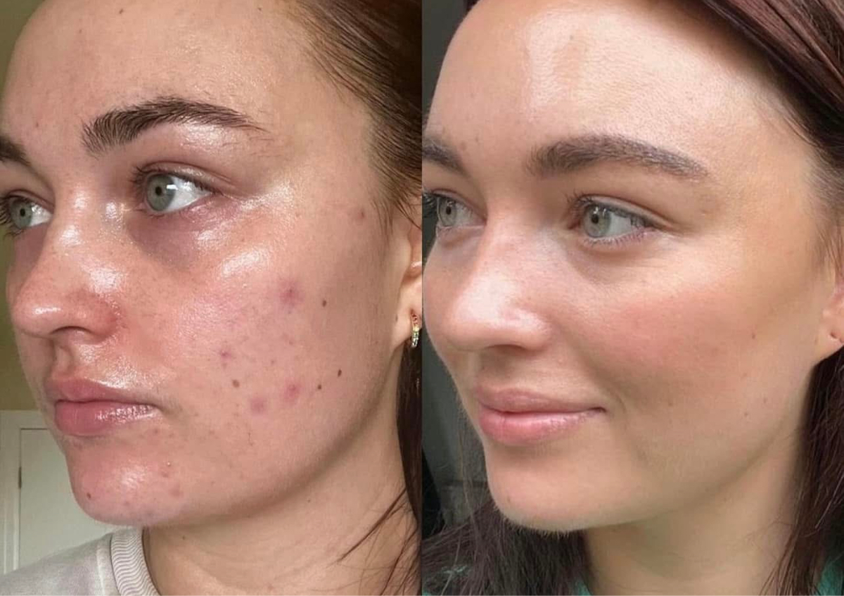 8 Week Acne Bootcamp Consultation