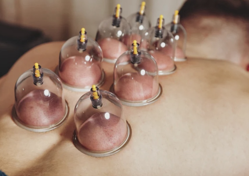 Dry Cupping 