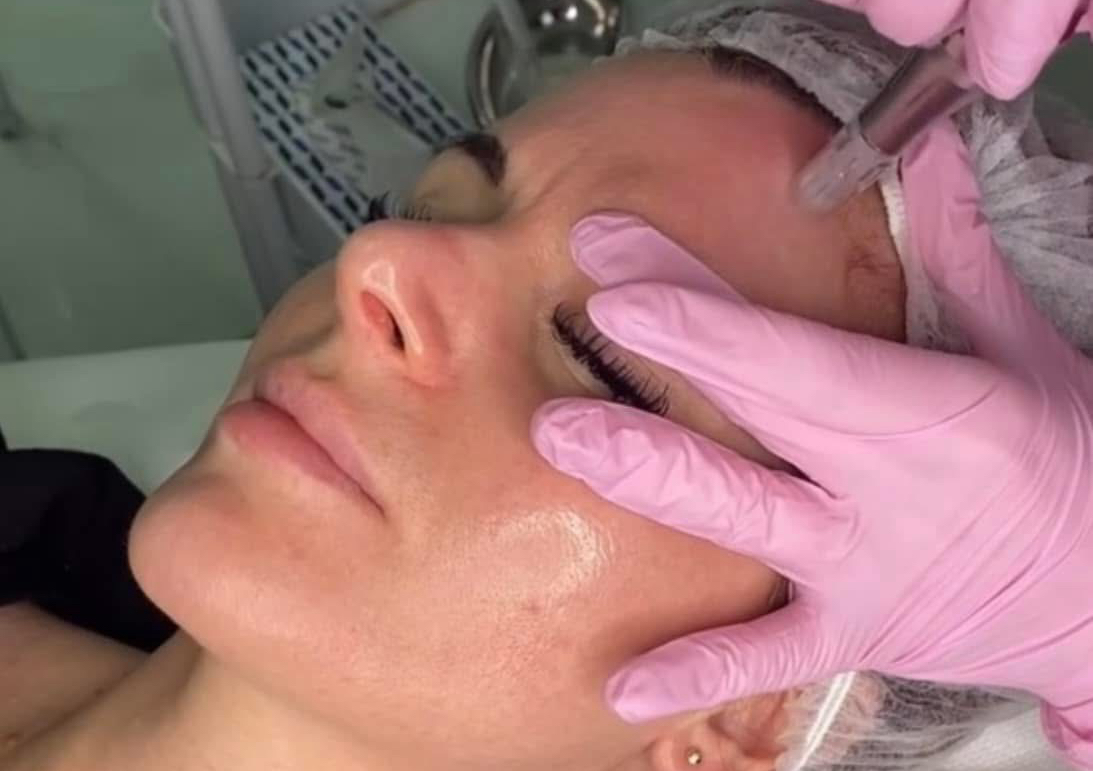 Microneedling x 4 