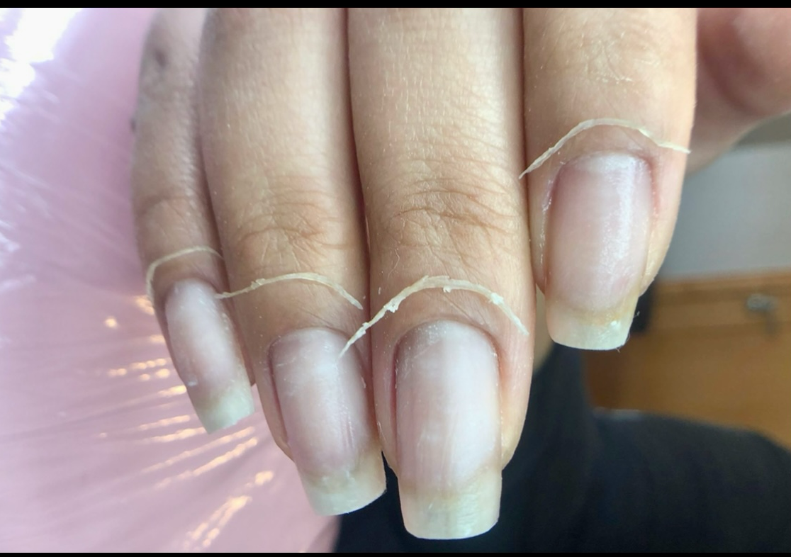 Only cuticle removal