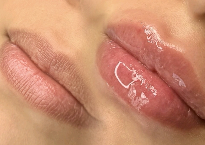 Hyaluron Pen Lip Filler