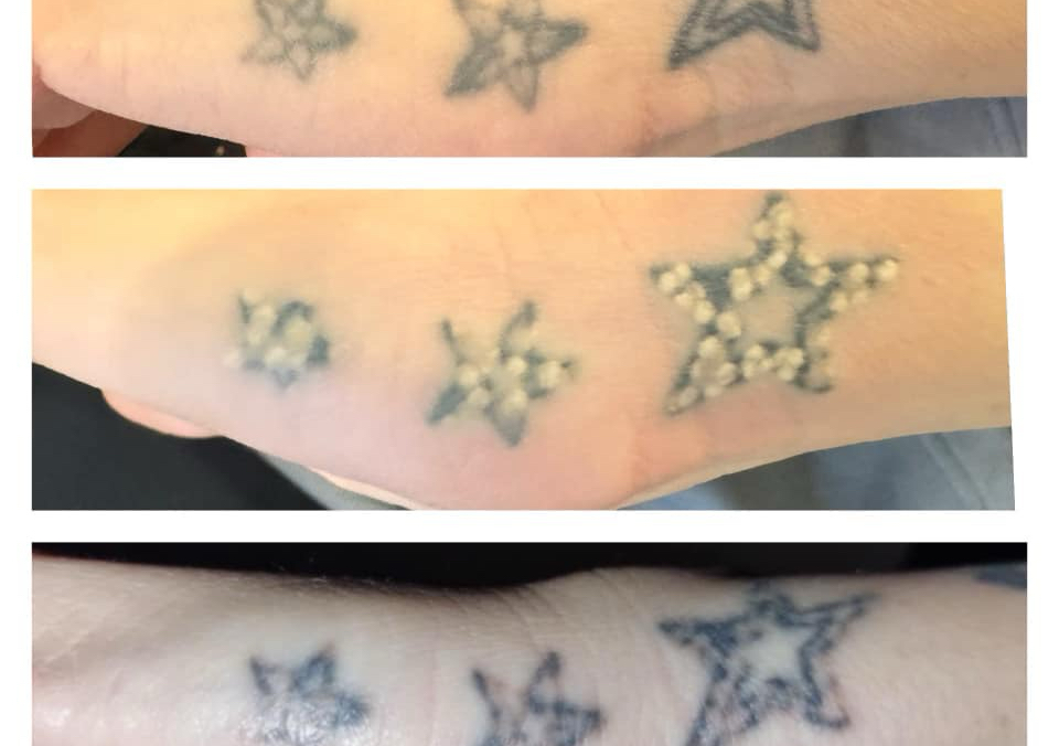 Tattoo removal 