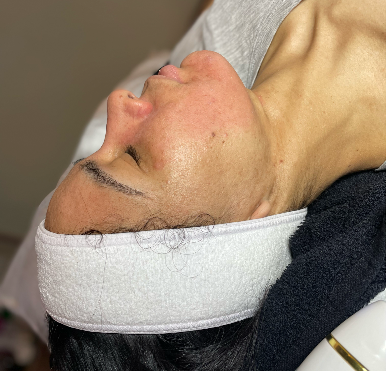 Microdermabrasion